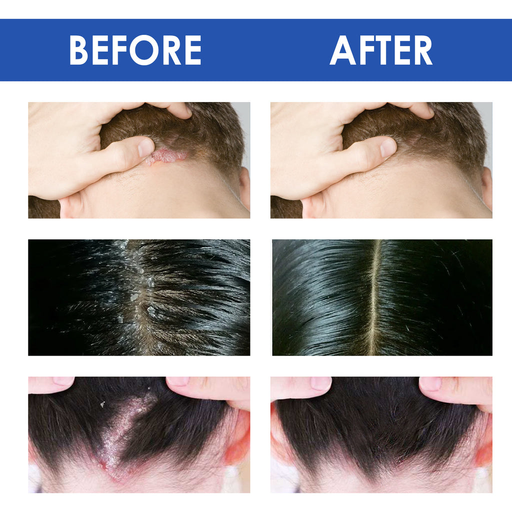 South Moon Seborrheic Dermatitis Skin Repair Cream